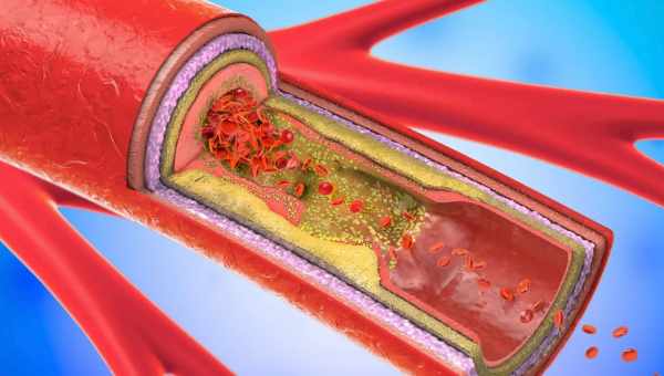Клітинна чистка рятує від атеросклерозу